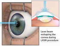 laser