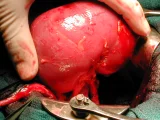 L’urologie de demain : la révolution mini-invasive
