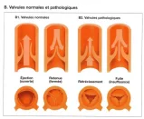 L’évolution du dépistage et des traitements des valvulopathies depuis 20-30 ans