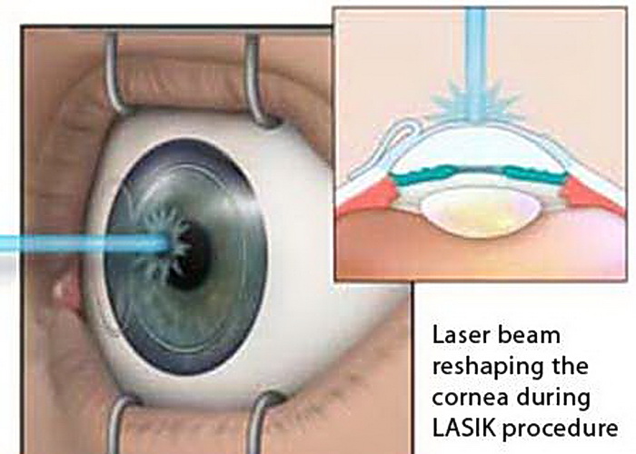 laser oeil